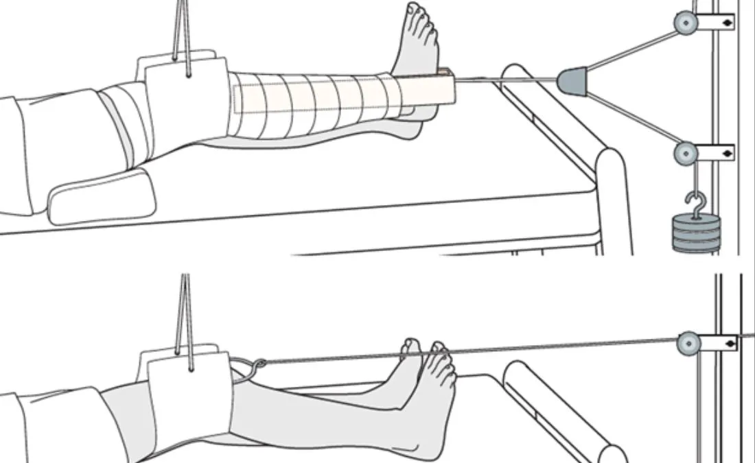 Buck's traction - Definition and Examples - Biology Online Dictionary