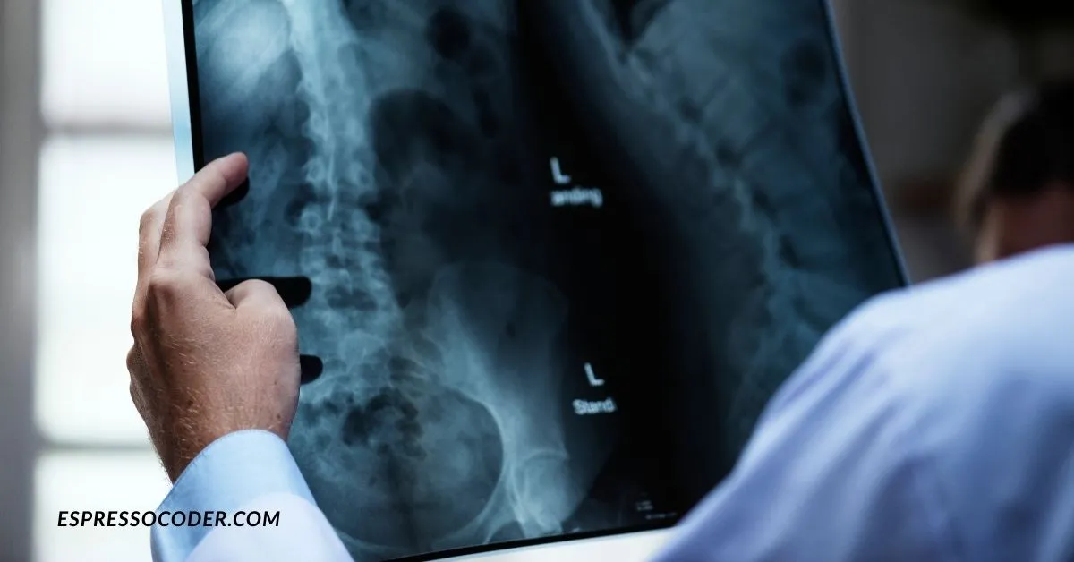 Osteoarthritis X-ray showing cartilage damage in hip joint.